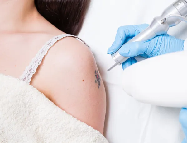 Можно ли избавиться от татуировок, чтобы не оставались шрамы