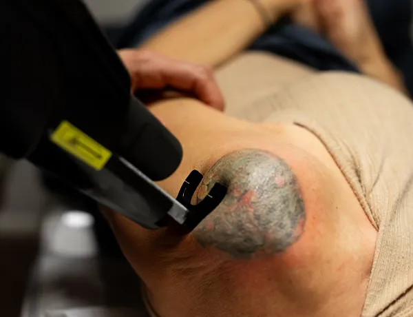 Удаление татуировок лазером