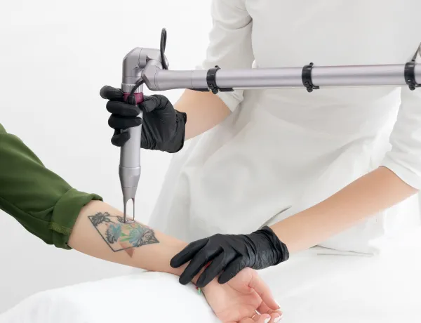 Как удалить татуировки