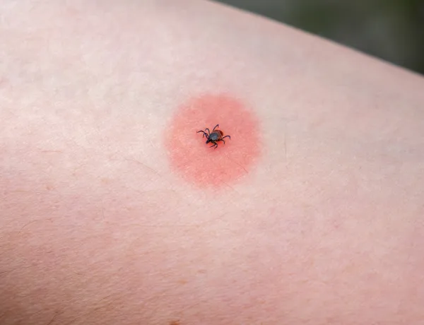 Что будет если укусил клещ